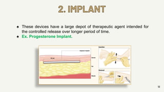 2. IMPLANT
12
♠ These devices have a large depot of therapeutic agent intended for
the controlled release over longer period of time.
♠ Ex. Progesterone Implant.
 