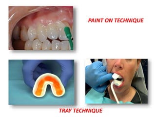 PAINT ON TECHNIQUE
TRAY TECHNIQUE
 