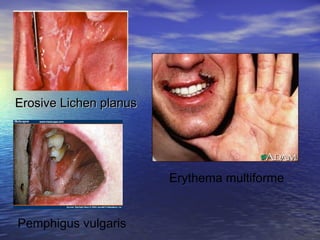 Erosive Lichen planusErosive Lichen planus
Pemphigus vulgaris
Erythema multiforme
 