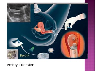 Embryo Transfer
 