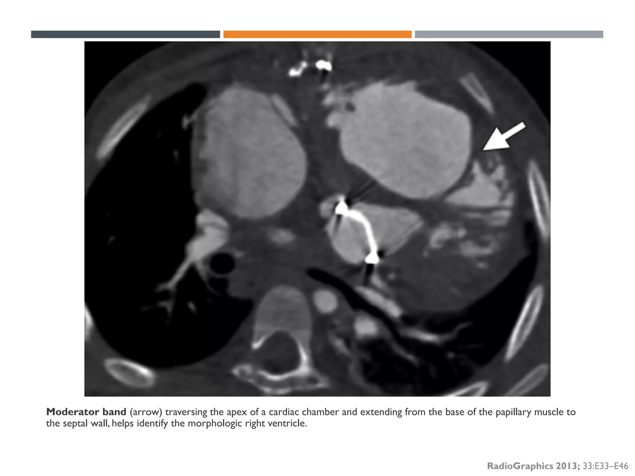 Segmental approach to Congenital Heart Disease | PDF