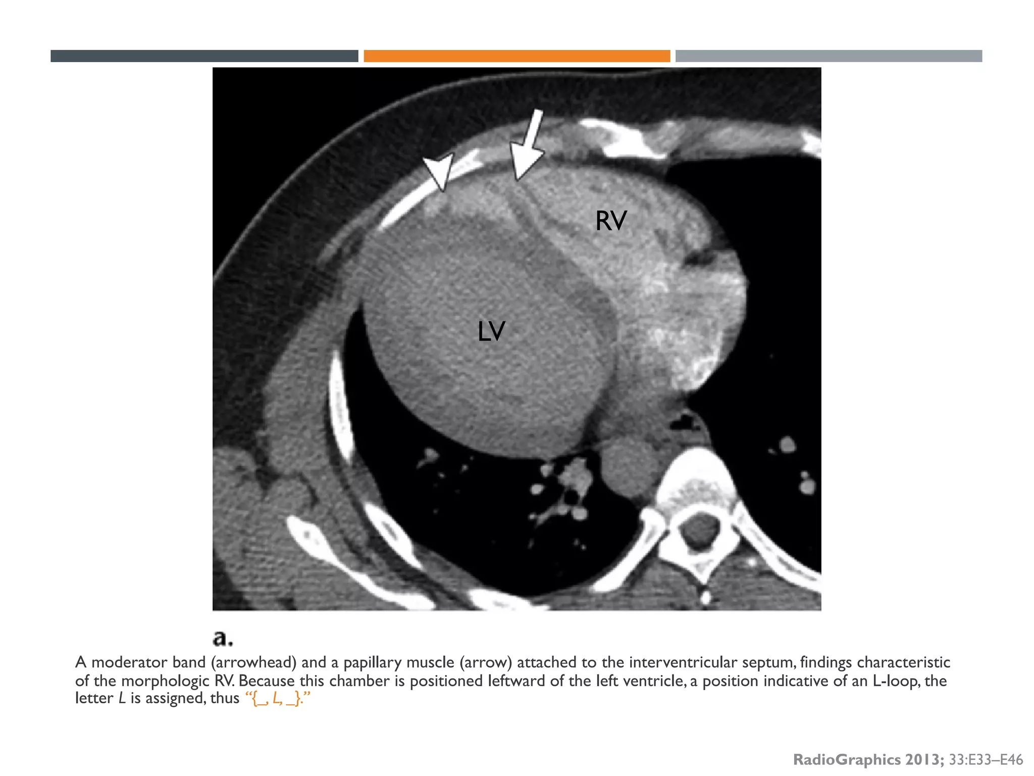 Segmental approach to Congenital Heart Disease | PDF