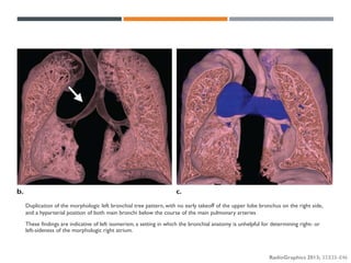Segmental approach to Congenital Heart Disease | PDF