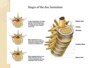 Surgery & anatomy of vertebral column and spinal nerves | PPTX