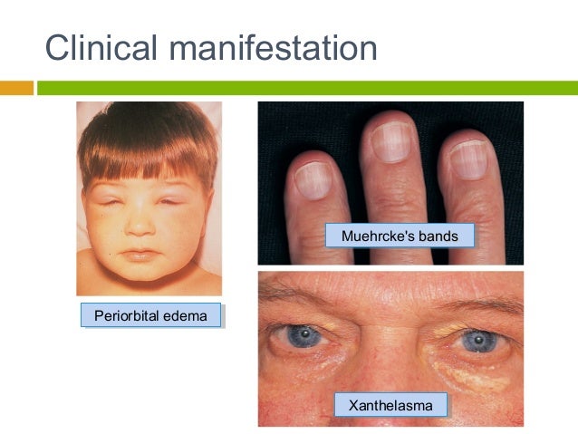 Stye Sufferer Cvs Has The Relief You Need - 4jznjdb