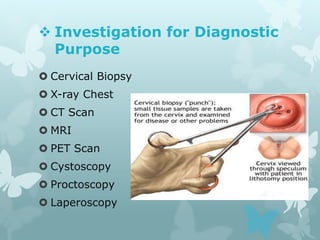  Investigation for Diagnostic
Purpose
 Cervical Biopsy
 X-ray Chest
 CT Scan
 MRI
 PET Scan
 Cystoscopy
 Proctoscopy
 Laperoscopy
 
