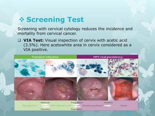 Screening Test
Screening with cervical cytology reduces the incidence and
mortality from cervical cancer.
 VIA Test: Visual inspection of cervix with acetic acid
(3.5%). Here acetowhite area in cervix considered as a
VIA positive.
 