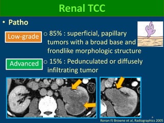 Renal TCC
• Patho
o 85% : superficial, papillary
tumors with a broad base and
frondlike morphologic structure
o 15% : Pedunculated or diffusely
infiltrating tumor
Ronan FJ Browne et al, Radiographics 2005
Advanced
Low-grade
 
