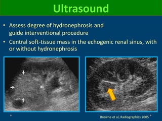 • Assess degree of hydronephrosis and
guide interventional procedure
• Central soft-tissue mass in the echogenic renal sinus, with
or without hydronephrosis
Ultrasound
Browne et al, Radiographics 2005
 