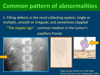 Common pattern of abnormalities
1. Filling defects in the renal collecting system; single or
multiple, smooth or irregular, and sometimes stippled
“The stipple sign” - contrast medium in the tumor’s
papillary fronds
Raghunandan Vikram et al, AJR 2009
Ronan FJ Browne et al, Radiographics 2005
 