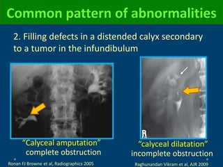 2. Filling defects in a distended calyx secondary
to a tumor in the infundibulum
Common pattern of abnormalities
Ronan FJ Browne et al, Radiographics 2005
“Calyceal amputation”
complete obstruction
“calyceal dilatation”
incomplete obstruction
Raghunandan Vikram et al, AJR 2009
 