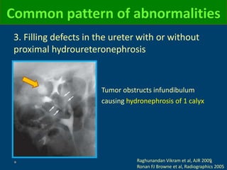 3. Filling defects in the ureter with or without
proximal hydroureteronephrosis
Common pattern of abnormalities
Tumor obstructs infundibulum
causing hydronephrosis of 1 calyx
Raghunandan Vikram et al, AJR 2009
Ronan FJ Browne et al, Radiographics 2005
 