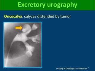 Oncocalyx: calyces distended by tumor
Excretory urography
Imaging in Oncology, Second Edition
 