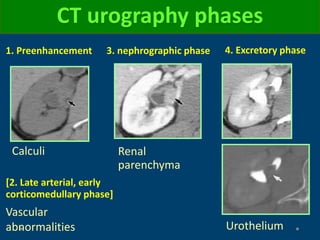 Calculi
CT urography phases
Vascular
abnormalities Urothelium
3. nephrographic phase1. Preenhancement 4. Excretory phase
[2. Late arterial, early
corticomedullary phase]
Renal
parenchyma
 