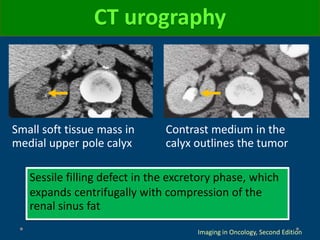Sessile filling defect in the excretory phase, which
expands centrifugally with compression of the
renal sinus fat
Imaging in Oncology, Second Edition
CT urography
Small soft tissue mass in
medial upper pole calyx
Contrast medium in the
calyx outlines the tumor
 
