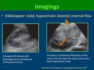 Imagings
Borhani et al, Diagnostic imaging genitourinary 3rded
• US&Doppler: Solid, hypoechoeic lesion(s) internal flow
Enlarged left kidney with
heterogeneous echotexture
of the parenchyma
Rt kidney: ill-defined infiltration of the
renal sinus fat near the lower pole and a
focal hypoechoic mass
 