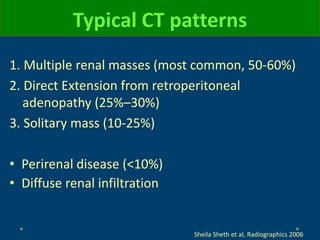 Typical CT patterns
1. Multiple renal masses (most common, 50-60%)
2. Direct Extension from retroperitoneal
adenopathy (25%–30%)
3. Solitary mass (10-25%)
• Perirenal disease (<10%)
• Diffuse renal infiltration
Sheila Sheth et al, Radiographics 2006
 