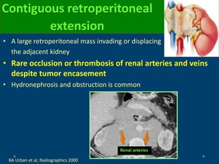 • A large retroperitoneal mass invading or displacing
the adjacent kidney
• Rare occlusion or thrombosis of renal arteries and veins
despite tumor encasement
• Hydronephrosis and obstruction is common
Contiguous retroperitoneal
extension
BA Urban et al, Radiographics 2000
Renal arteries
 