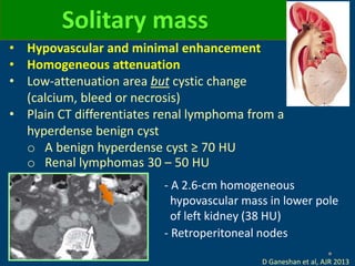 Solitary mass
- A 2.6-cm homogeneous
hypovascular mass in lower pole
of left kidney (38 HU)
- Retroperitoneal nodes
D Ganeshan et al, AJR 2013
• Hypovascular and minimal enhancement
• Homogeneous attenuation
• Low-attenuation area but cystic change
(calcium, bleed or necrosis)
• Plain CT differentiates renal lymphoma from a
hyperdense benign cyst
o A benign hyperdense cyst ≥ 70 HU
o Renal lymphomas 30 – 50 HU
 