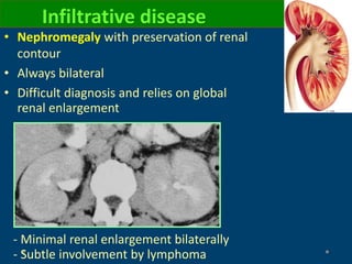 • Nephromegaly with preservation of renal
contour
• Always bilateral
• Difficult diagnosis and relies on global
renal enlargement
Infiltrative disease
- Minimal renal enlargement bilaterally
- Subtle involvement by lymphoma
 