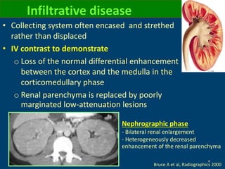 • Collecting system often encased and strethed
rather than displaced
• IV contrast to demonstrate
o Loss of the normal differential enhancement
between the cortex and the medulla in the
corticomedullary phase
o Renal parenchyma is replaced by poorly
marginated low-attenuation lesions
Infiltrative disease
Nephrographic phase
- Bilateral renal enlargement
- Heterogeneously decreased
enhancement of the renal parenchyma
Bruce A et al, Radiographics 2000
 