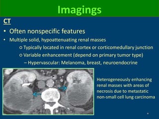 Imagings
CT
• Often nonspecific features
• Multiple solid, hypoattenuating renal masses
○ Typically located in renal cortex or corticomedullary junction
○ Variable enhancement (depend on primary tumor type)
– Hypervascular: Melanoma, breast, neuroendocrine
Heterogeneously enhancing
renal masses with areas of
necrosis due to metastatic
non-small cell lung carcinoma
 