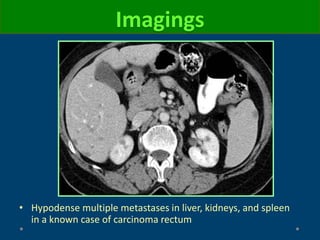• Hypodense multiple metastases in liver, kidneys, and spleen
in a known case of carcinoma rectum
Imagings
 