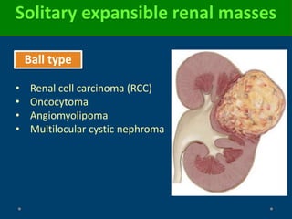 Solitary expansible renal masses
Ball type
• Renal cell carcinoma (RCC)
• Oncocytoma
• Angiomyolipoma
• Multilocular cystic nephroma
 