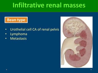 Infiltrative renal masses
Bean type
• Urothelial cell CA of renal pelvis
• Lymphoma
• Metastasis
 