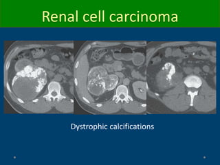Renal cell carcinoma
Dystrophic calcifications
 