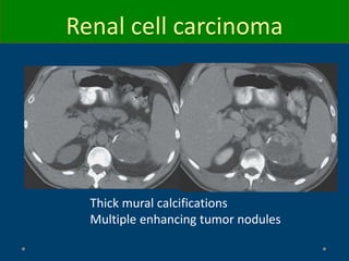 Thick mural calcifications
Multiple enhancing tumor nodules
Renal cell carcinoma
 