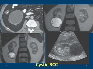 Cystic RCC
 