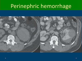 Perinephric hemorrhage
 