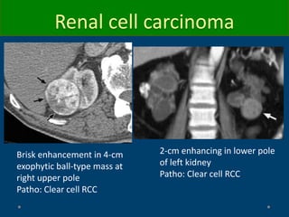 Brisk enhancement in 4-cm
exophytic ball-type mass at
right upper pole
Patho: Clear cell RCC
2-cm enhancing in lower pole
of left kidney
Patho: Clear cell RCC
Renal cell carcinoma
 