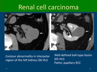 Contour abnormality in interpolar
region of the left kidney (36 HU)
Well-defined ball-type lesion
(65 HU)
Patho: papillary RCC
Renal cell carcinoma
 