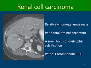 Relatively homogeneous mass
Peripheral rim enhancement
A small focus of dystrophic
calcification
Patho: Chromophobe RCC
Renal cell carcinoma
 