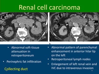 Renal cell carcinoma
• Abnormal soft-tissue
attenuation in
retroperitoneum
• Perinephric fat infiltration
• Enlargement of left renal vein and
IVC due to intravenous invasion
• Abnormal pattern of parenchymal
enhancement in anterior hilar lip
on the left
• Retroperitoneal lymph nodes
Collecting duct
 