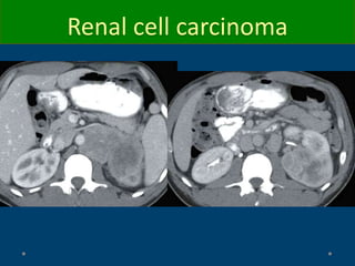 Renal cell carcinoma
 