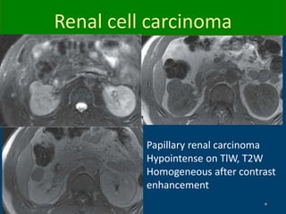 Papillary renal carcinoma
Hypointense on TlW, T2W
Homogeneous after contrast
enhancement
Renal cell carcinoma
 