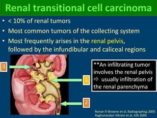 Renal transitional cell carcinoma
• < 10% of renal tumors
• Most common tumors of the collecting system
• Most frequently arises in the renal pelvis,
followed by the infundibular and caliceal regions
Ronan FJ Browne et al, Radiographics 2005
Raghunandan Vikram et al, AJR 2009
1
3
2
**An infiltrating tumor
involves the renal pelvis
 usually infiltration of
the renal parenchyma
 