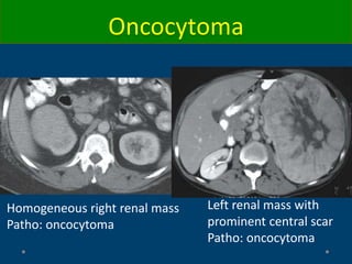 Homogeneous right renal mass
Patho: oncocytoma
Left renal mass with
prominent central scar
Patho: oncocytoma
Oncocytoma
 