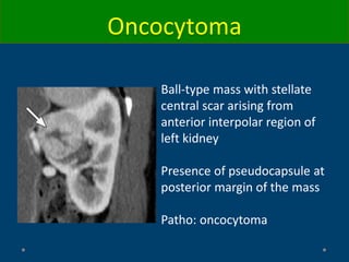 Ball-type mass with stellate
central scar arising from
anterior interpolar region of
left kidney
Presence of pseudocapsule at
posterior margin of the mass
Patho: oncocytoma
Oncocytoma
 