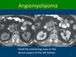 Small fat containing mass in the
dorsal aspect of the left kidney
Angiomyolipoma
 