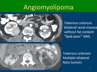 Tuberous sclerosis
bilateral renal masses
without fat content
"lipid-poor” AML
Tuberous sclerosis
Multiple bilateral
fatty tumors
Angiomyolipoma
 