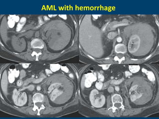 AML with hemorrhage
 