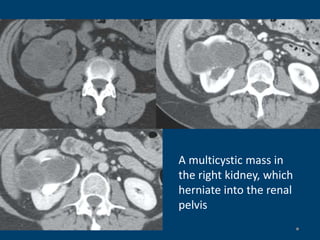 A multicystic mass in
the right kidney, which
herniate into the renal
pelvis
 