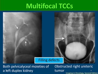 Multifocal TCCs
Both pelvicalyceal moieties of
a left duplex kidney
Obstructed right ureteric
tumor
Imaging in Oncology, Second Edition
Filling defects
 