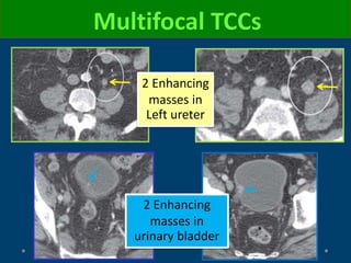 Multifocal TCCs
2 Enhancing
masses in
Left ureter
2 Enhancing
masses in
urinary bladder
 