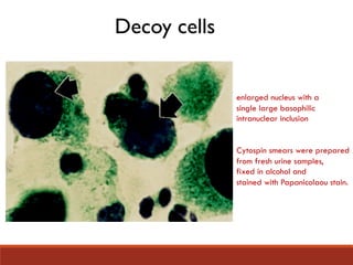 Decoy cells
enlarged nucleus with a
single large basophilic
intranuclear inclusion
Cytospin smears were prepared
from fresh urine samples,
fixed in alcohol and
stained with Papanicolaou stain.
 