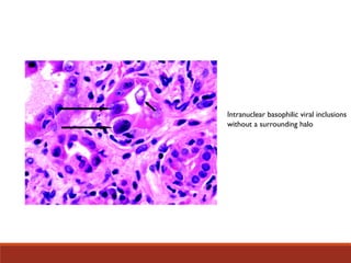 Intranuclear basophilic viral inclusions
without a surrounding halo
 